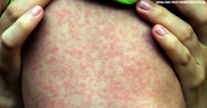 New York City declares a public health emergency amid Brooklyn measles outbreak