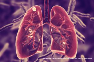 San Diego public health officials are confirming three cases of tuberculosis.